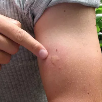 Malaria: Why some people get bitten by mosquitoes more than others?